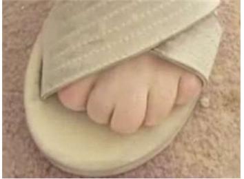 Fewest Toenails On A Foot