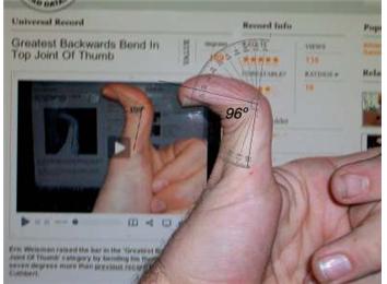 Greatest Backwards Bend In Top Joint Of Thumb