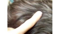 Most Patches Of Gray Hair 