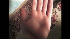 Most Freckles On Palms
