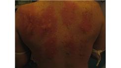 Most Allergic Reactions In 15 Minutes