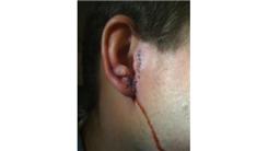 Most Stitches In An Ear