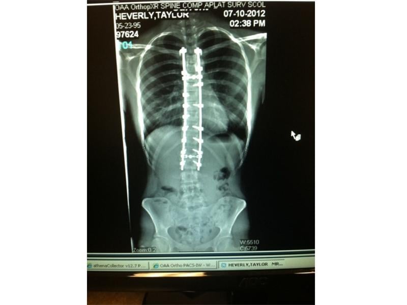 Most Screws Surgically Implanted Into Spine