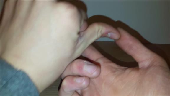 Greatest Backwards Bend In Top Joint Of Thumb
