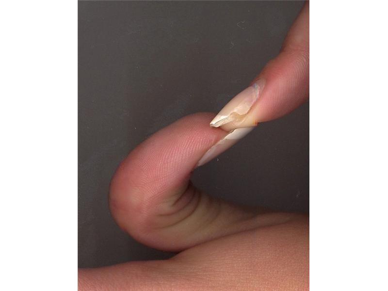 Greatest Assisted Backwards Bend In Top Joint Of Thumb