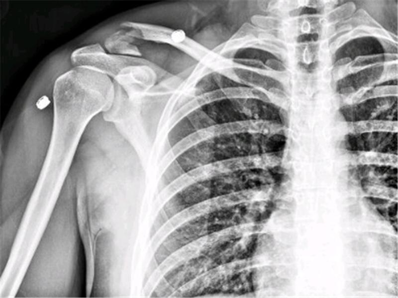 Longest Time With Broken Clavicle Before Having Surgery